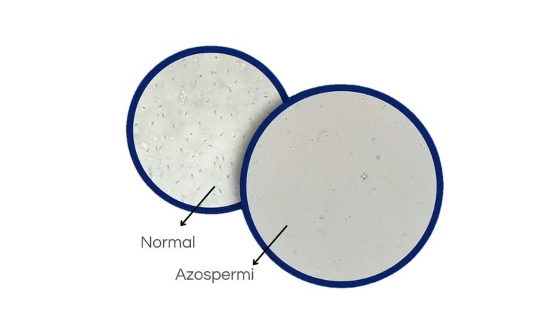 Azospermi (Sperm Yokluğu) Tedavisi: Mikro TESE ile Baba Olma Şansı