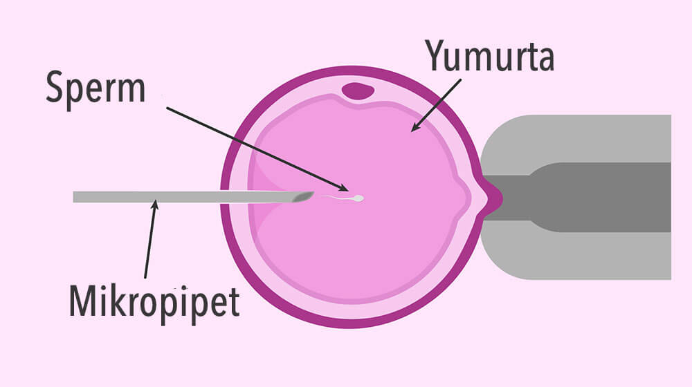 Mikroenjeksiyon (ICSI) Nedir?